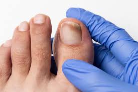 Severe fungal foot infection